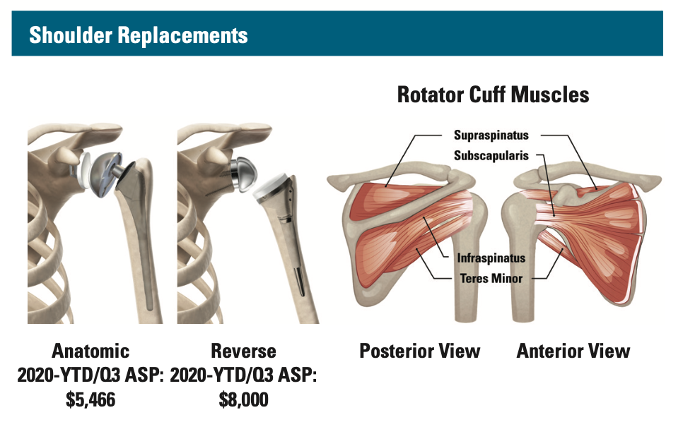 Shoulder Replacements - 2021 ONN